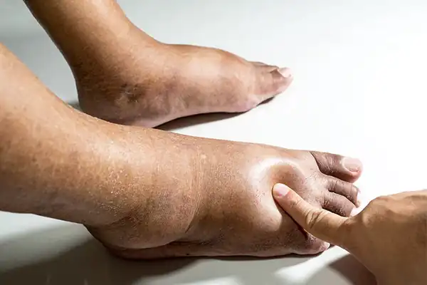 تعبیر خواب ورم ابن سیرین + برای زن متاهل و باردار و دختر مجرد