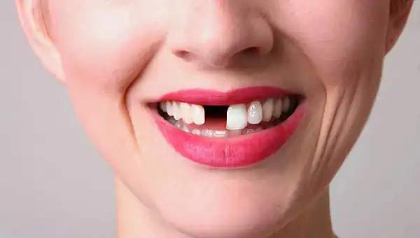 تعبیر خواب دندان ریختن + برای زن متاهل و باردار و دختر مجرد