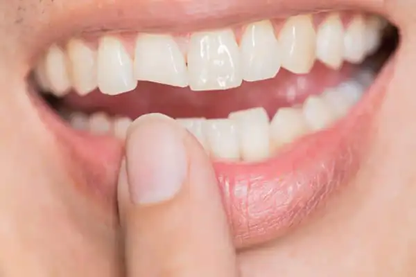تعبیر خواب دندان شکسته + برای زن متاهل و باردار و دختر مجرد
