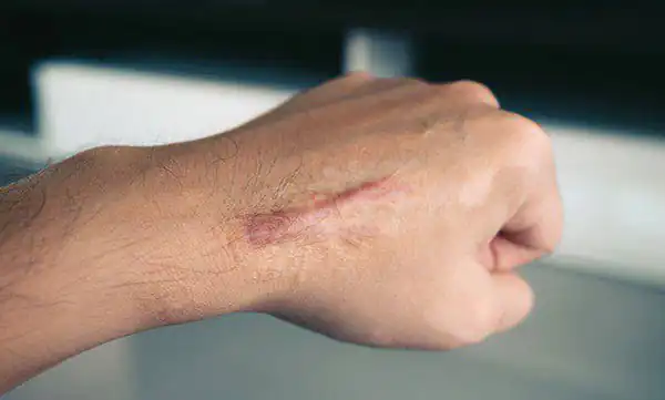 تعبیر خواب گوشت اضافه در بدن برای دختر مجرد و زن متاهل و باردار و مطلقه