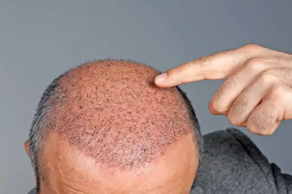 تعبیر خواب مو درآوردن سر انسان + برای زن متاهل و باردار و دختر مجرد