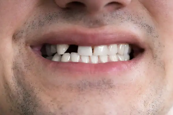 تعبیر خواب افتادن دندان جلو + برای زن متاهل و باردار و دختر مجرد