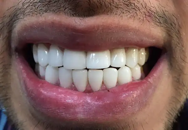 تعبیر خواب دندان بالا + برای زن متاهل و باردار و دختر مجرد