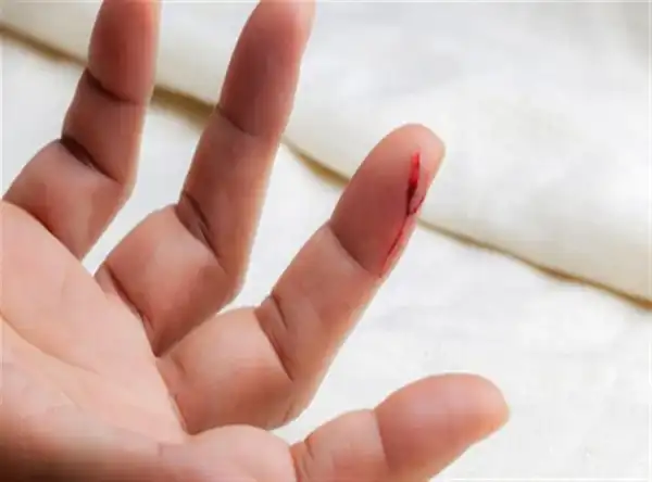 تعبیر خواب دست زخمی + برای زن متاهل و باردار و دختر مجرد