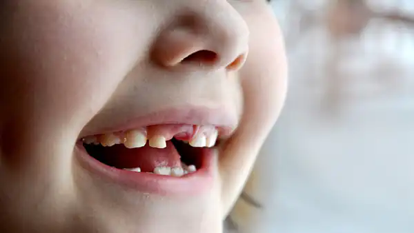 تعبیر خواب افتادن دندان شیری کودک + برای زن متاهل و باردار و دختر مجرد