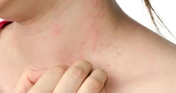 تعبیر خواب جوش روی سینه + برای زن متاهل و باردار و دختر مجرد