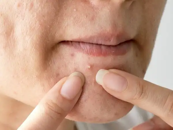 تعبیر خواب ترکیدن جوش چرکی + برای زن متاهل و باردار و دختر مجرد