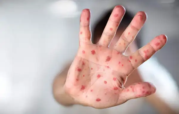 تعبیر خواب بیماری واگیردار + برای زن متاهل و باردار و دختر مجرد
