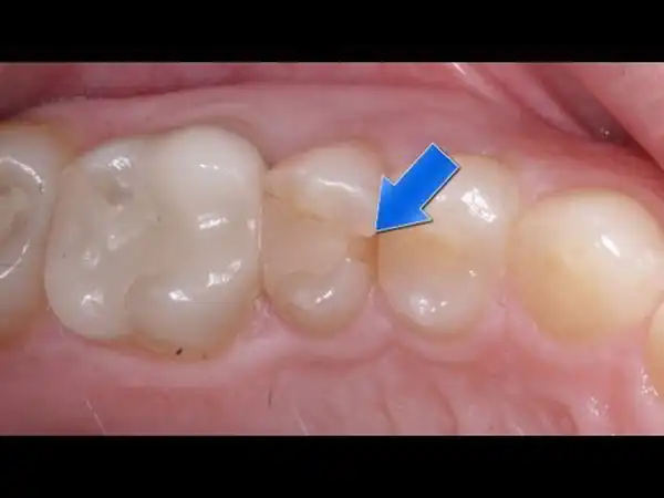 تعبیر خواب افتادن دندان آسیاب ابن سیرین + برای زن متاهل و باردار و دختر مجرد